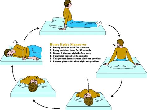 epley maneuver instructions with pictures